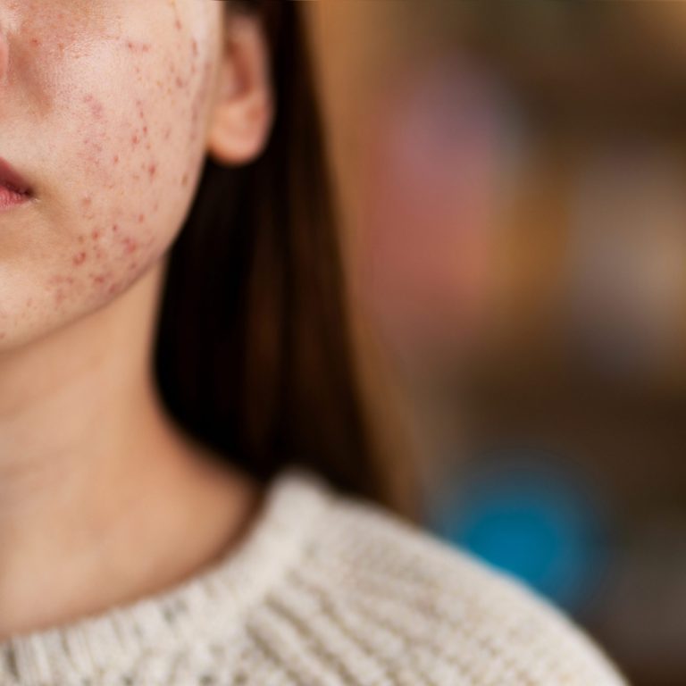 persona-che-si-occupa-di-rosacea